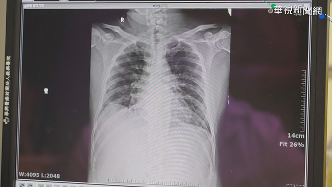 肺阻塞年奪5000條命 1分鐘爬30階自我檢測 | 華視新聞