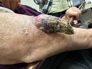 老婦手臂長「巨角」  家屬請示媽祖獲仙界轉診單