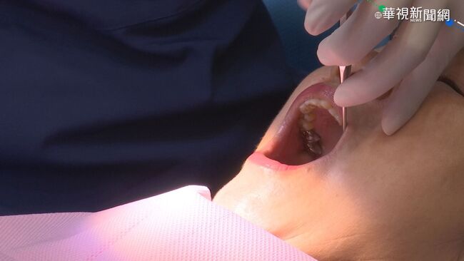 5歲女童患齲齒因疫情2年未回診 牙爛拔9顆 | 華視新聞
