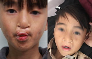 台醫療團操刀治好唇腭裂  越南小帥哥想當足球員