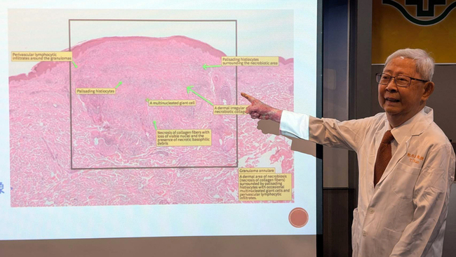 數十年皮膚病理研究  長庚數位化成線上影像系統 | 華視新聞