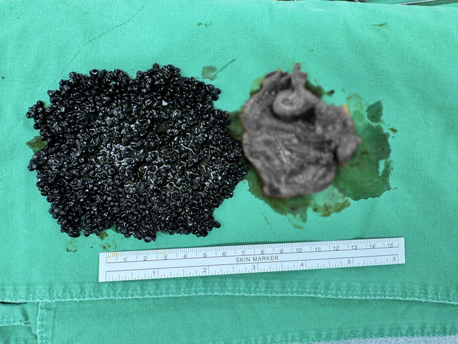 吃火鍋後腹痛開刀  取出大量「魚子醬狀」膽結石 | 華視新聞