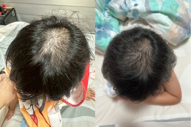 過度消毒惹禍 疫情寶寶過敏發病率增46% | 華視新聞