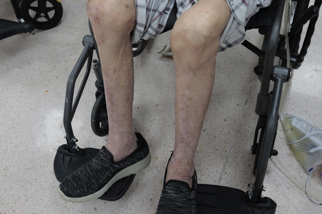 老婦常跌倒誤為骨質疏鬆  檢測診斷肌少症 | 華視新聞