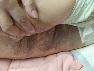 長者住護理之家多處瘀青被要求退住  彰縣府調查中