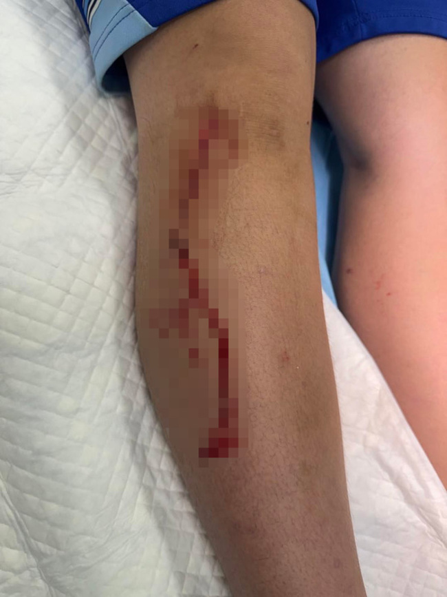 屏東開學首週2起校園暴力　學生遭毆打、美工刀劃傷 | 華視新聞