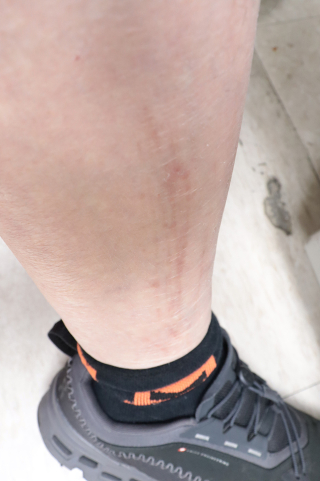 骨頭痠痛奇癢無比　中年男被診斷副甲狀腺功能亢進 | 華視新聞