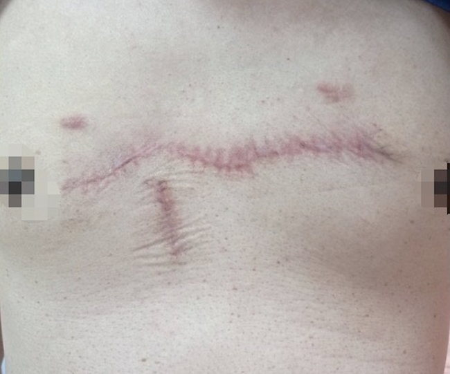 男子胸口青春痘釀蟹足腫　手術使用生物膜明顯改善 | 華視新聞