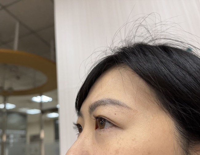 眼皮長黃色瘤別只靠醫美　醫師提醒恐是心血管警訊 | 華視新聞