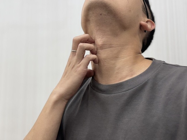 清明雨紛紛濕疹易反覆發作 中醫籲少油少甜適度運動