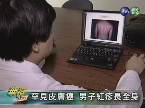 罕見皮膚癌 男子紅疹長全身 | 華視新聞