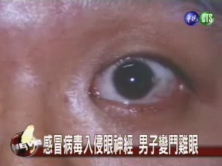 感冒病毒入侵眼神經 男子變鬥雞眼 | 華視新聞