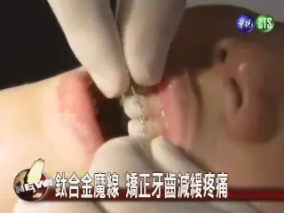 鈦合金魔線 矯正牙齒減緩疼痛 | 華視新聞