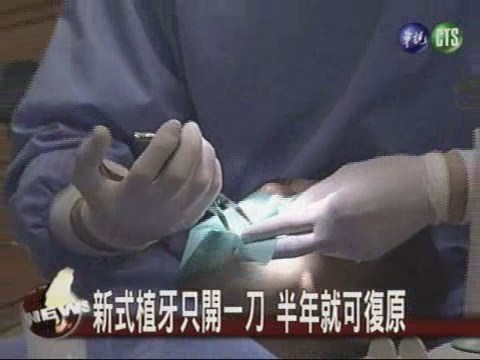 傳統植牙開刀四次復原期須兩年 | 華視新聞