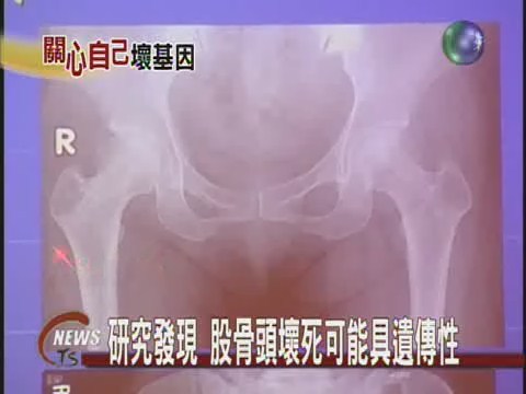 股骨頭壞死基因檢測治療 | 華視新聞