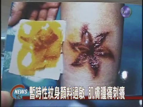 紋身顏料過敏 肌膚腫痛刺癢難耐 | 華視新聞