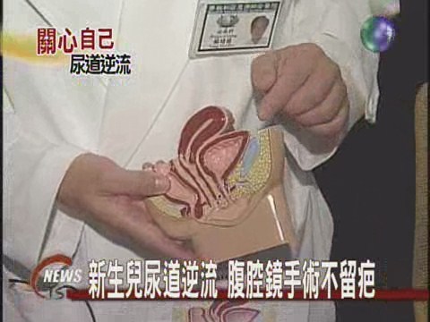 新生兒尿道逆流腹腔鏡術不留疤 | 華視新聞