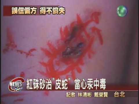 畫蜈蚣治"皮蛇"  當心汞中毒 | 華視新聞