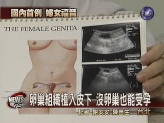 卵巢組織植入皮下 沒卵巢也能受孕