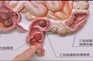 低位直腸癌新救星 肛門括約肌間分離手術