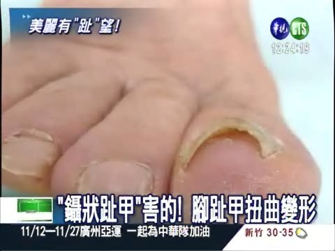 "鑷狀趾甲"害的 痛到走不了! | 華視新聞