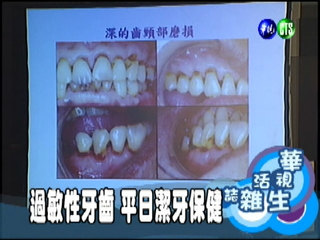 過敏性牙齒 平日潔牙保健