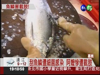 刮魚鱗染海洋弧菌 七旬阿嬤截肢