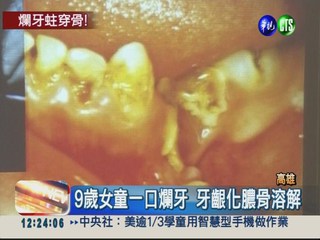乳牙蛀到骨頭溶解 下巴穿孔流膿!