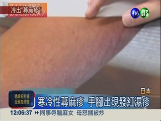 日本低溫積雪 冷出"寒冷性蕁麻疹"