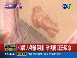 蟹足腫患者愛擠痘 疤痕消不掉