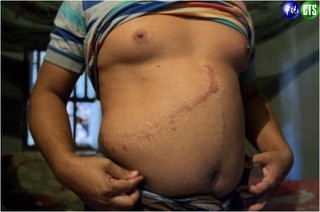 孟加拉兒童強摘腎 棄屍路邊