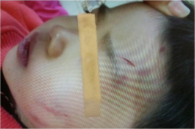 【午間搶先報】5歲女疑遭家暴 全身傷僅14公斤 | 華視新聞