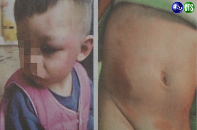 又傳虐童!? 1歲男娃滿身瘀青傷痕 | 華視新聞