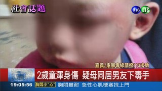 2歲童渾身傷 疑母同居人施暴