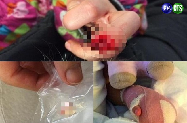 女童夾斷手指 保鮮袋緊急搶救接回 | 華視新聞