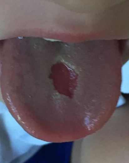 男童吃極酸糖 舌頭被燒出大洞 | 