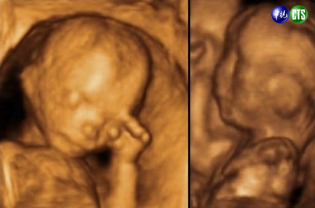 Baby超音波3D照 美FDA警告有危險 | 華視新聞