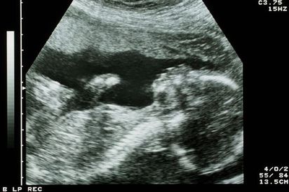 27周胎兒停止心跳 捧小腿照父母永存 | 