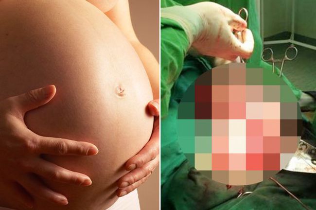 懷胎9個月 生出來的卻是5公斤的…… | 華視新聞