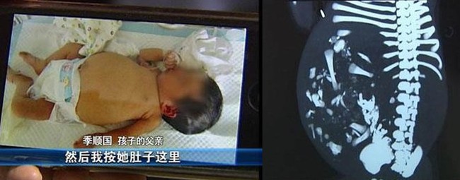 新生女嬰肚子大! 竟懷上「胎中胎」 | 華視新聞