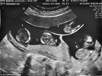 罕見! 英國四胞胎全是"異卵" | 超音波照片。
