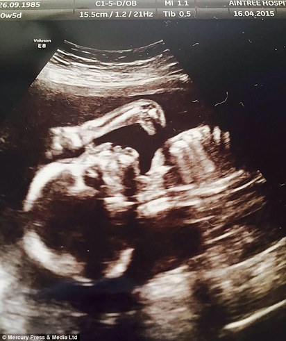 孕婦超音波照有雷龍? 寶寶出生前爆紅 | 