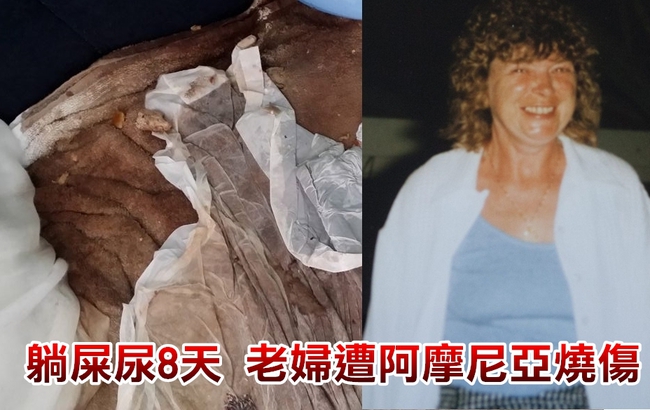 惡看護!老婦被自己的尿燒傷死亡 | 華視新聞