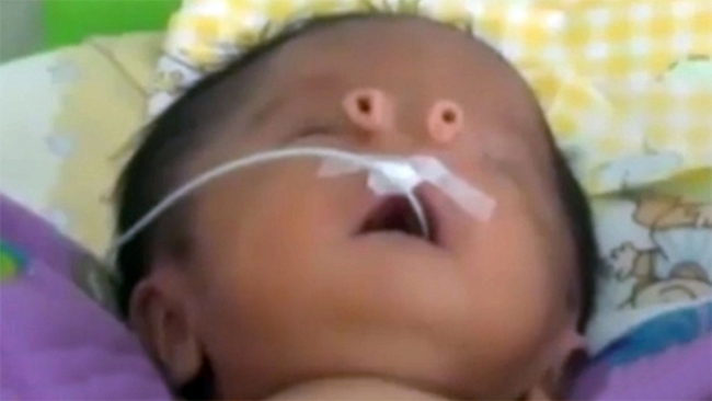 罕病男童出生有2個鼻子 父母取名「小天使」 | 華視新聞