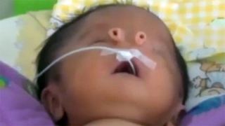 罕病男童出生有2個鼻子 父母取名「小天使」