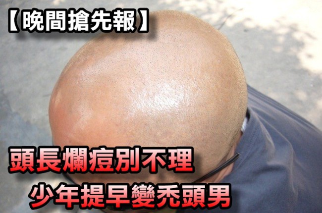 【晚間搶先報】頭長爛痘不理 少年提早變禿頭男 | 華視新聞