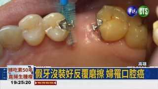 假牙沒裝好 反覆磨擦致口腔癌
