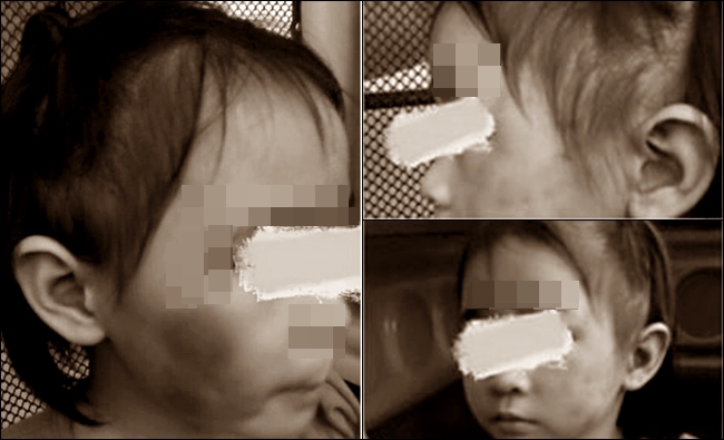 太狠心! 4歲女童遭繼父狂揍臉黑青 | 華視新聞