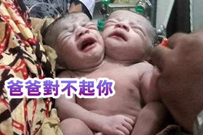 女兒出生有兩個頭 父「難過她生在窮人家」 | 華視新聞