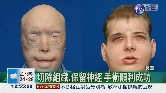 義消燒傷毀容 手術"變臉"重生 | 華視新聞